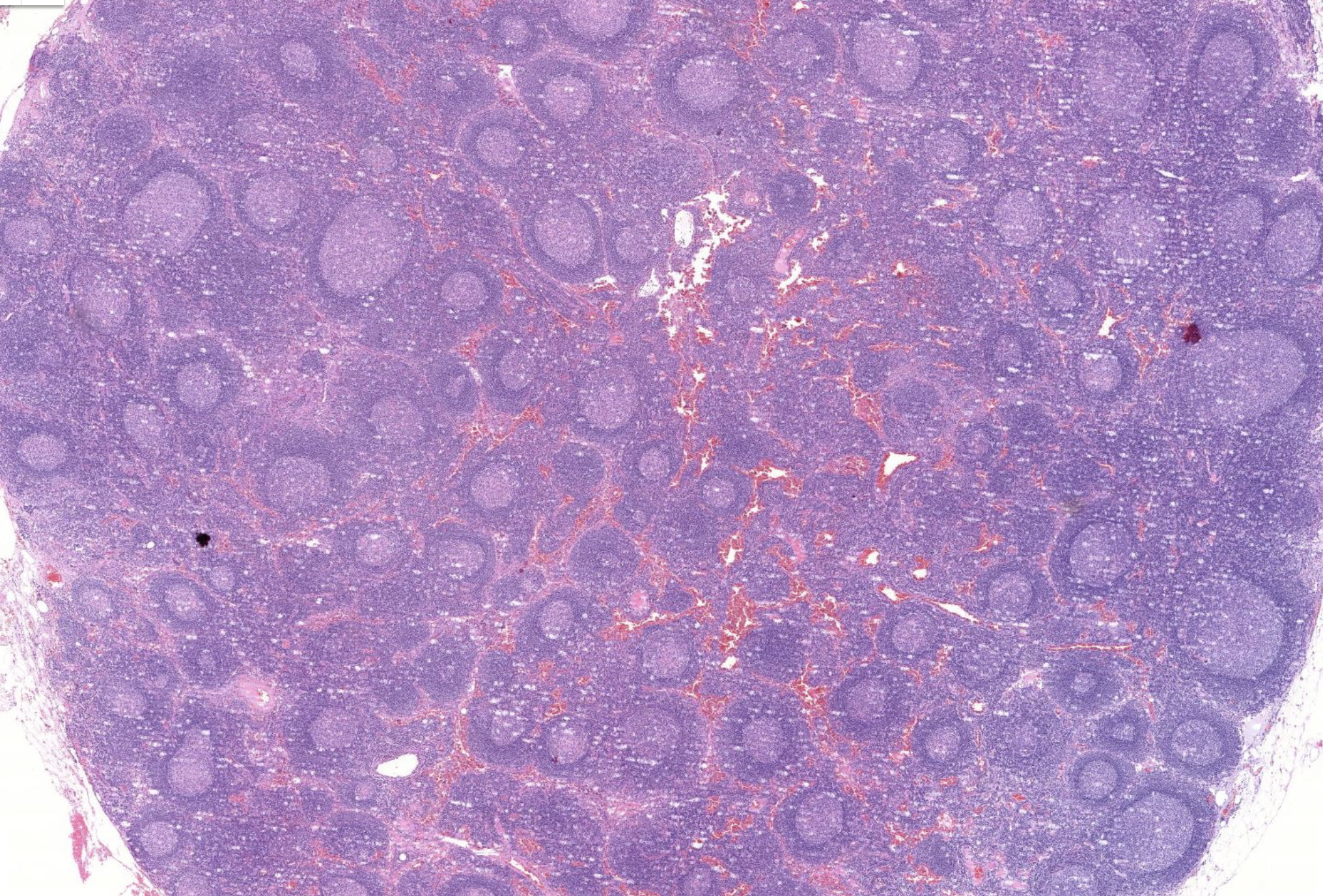 Histopathologisches Bild: Prostatahyperplasie mit knotiger Architektur